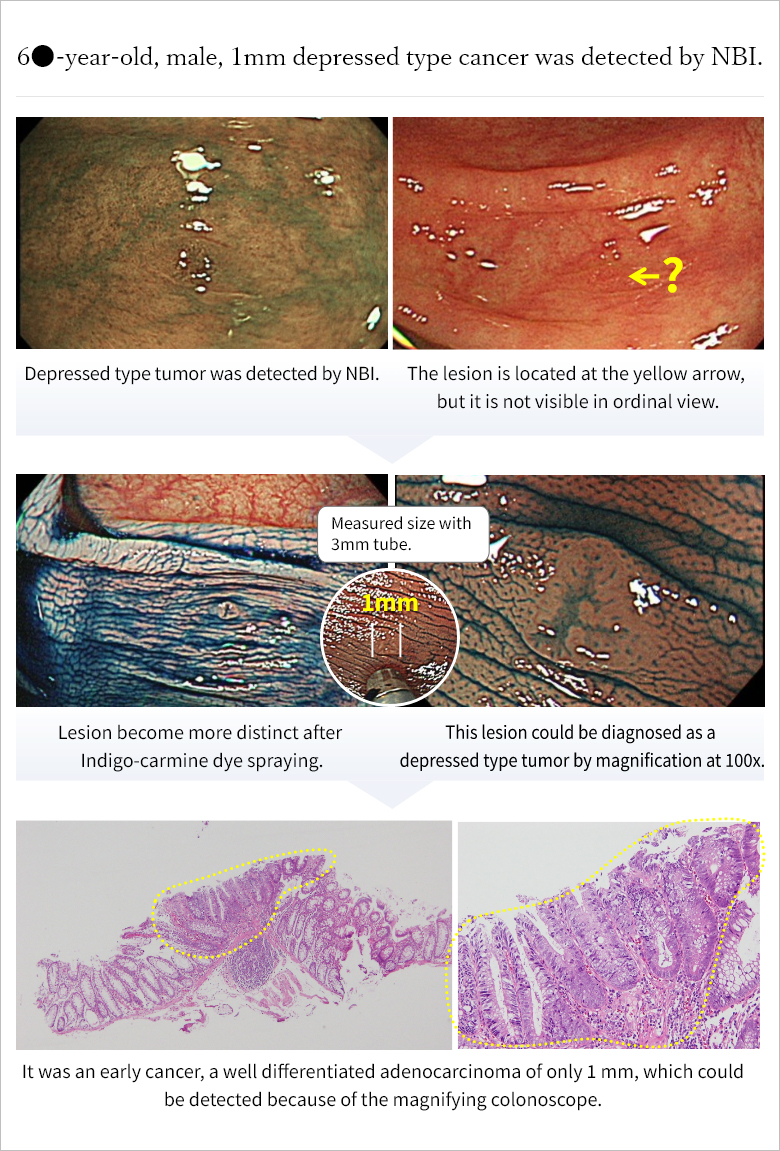 60代男性、1mmの陥凹型癌をNBIで発見