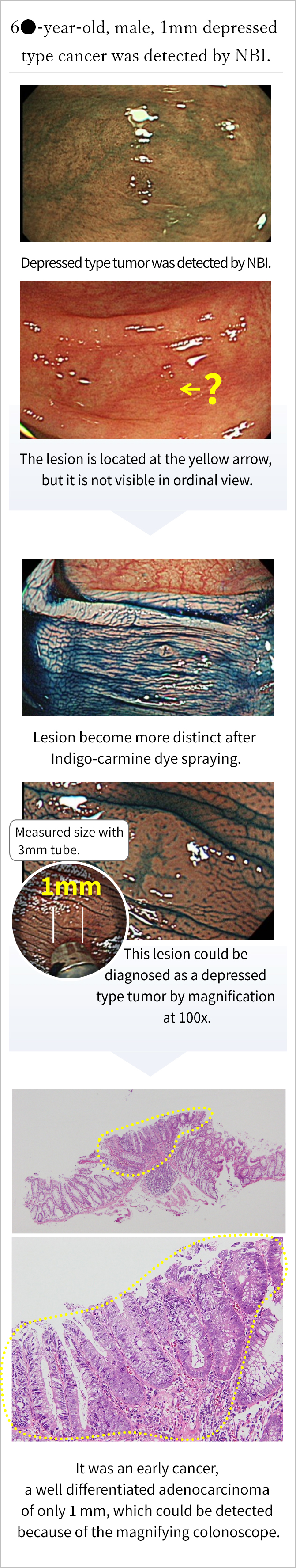 60代男性、1mmの陥凹型癌をNBIで発見