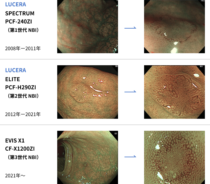 第一世代～第三世代のNBIの光量の比較写真