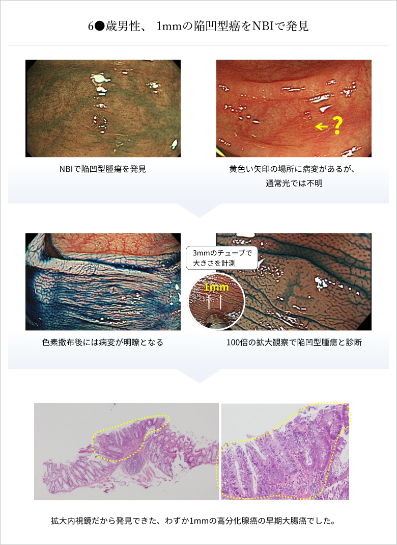 60代男性、1mmの陥凹型癌をNBIで発見