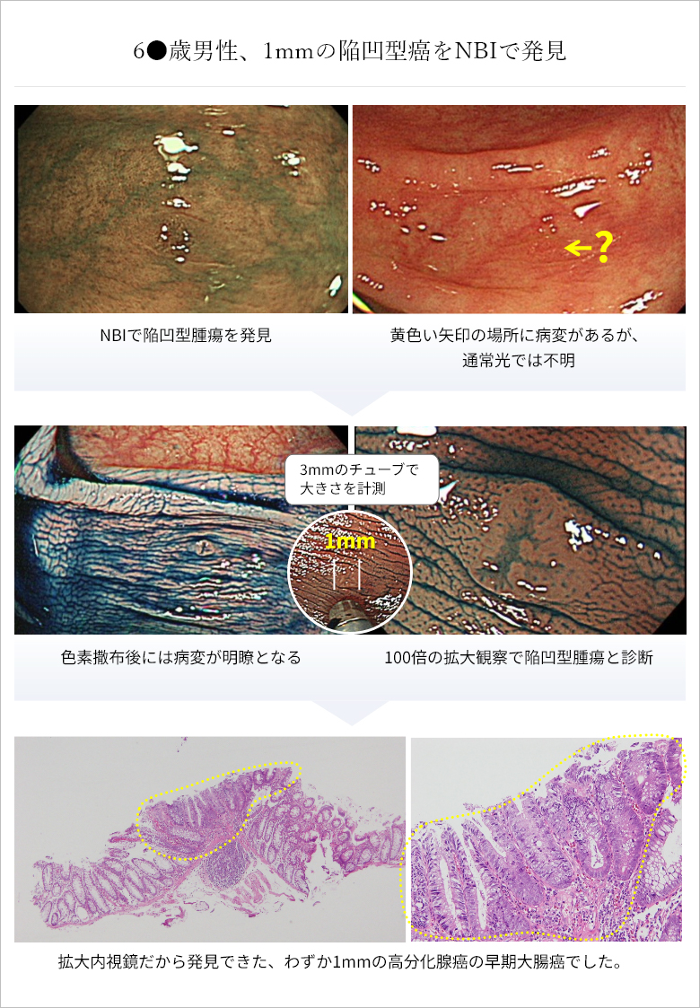 60代男性、1mmの陥凹型癌をNBIで発見