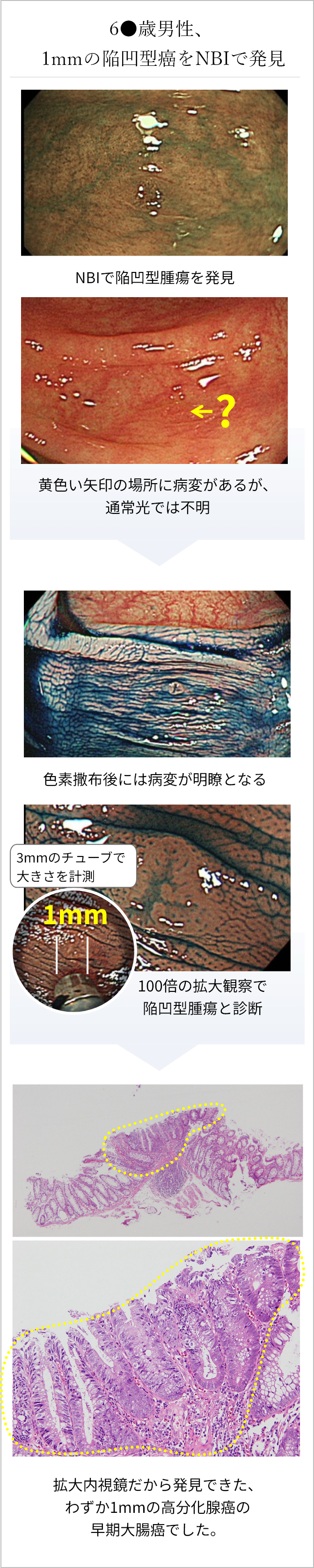 60代男性、1mmの陥凹型癌をNBIで発見